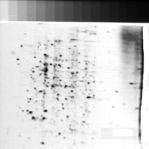 Acute Myelocytic Leukemia gel, scanned with the RTPP - Lester